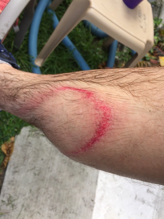 Reddit user's pressure washer injury